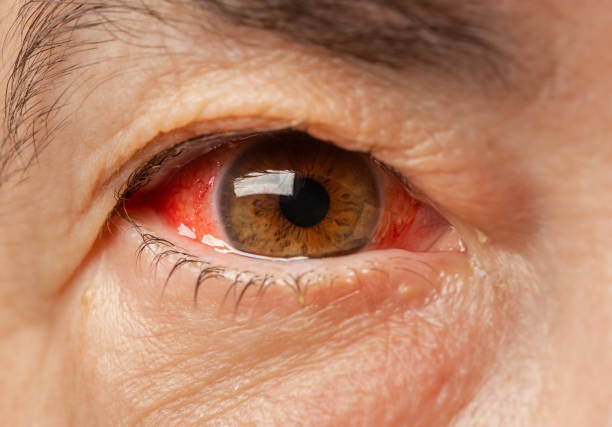 Glaucoma