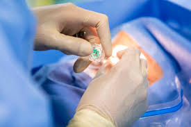 Inyecciones Intraoculares