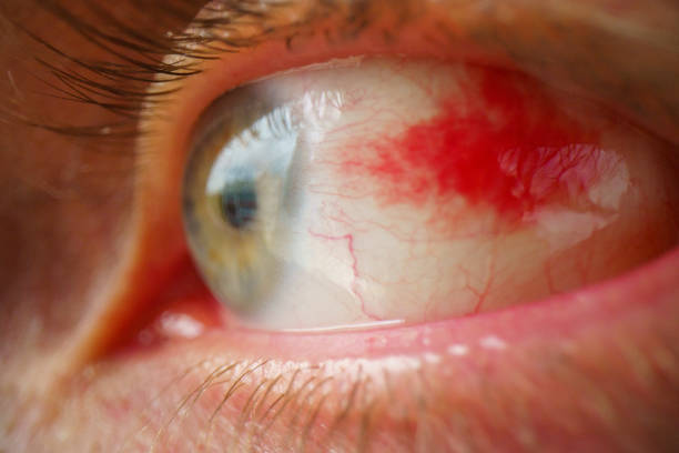 Tumor Palpebral