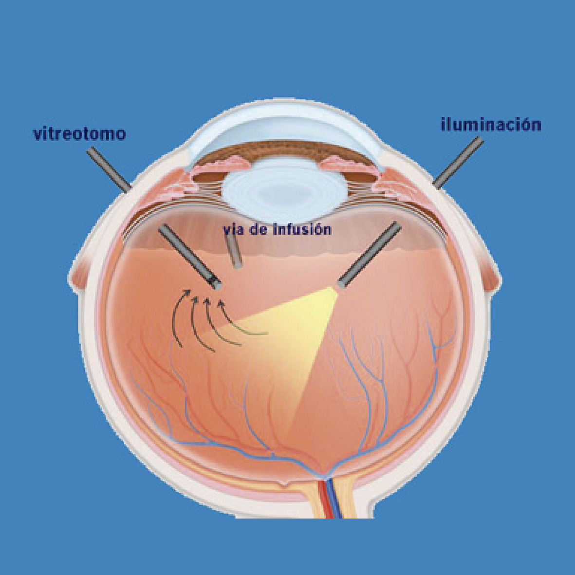 Vitrectomía